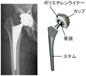 人工股関節の構造