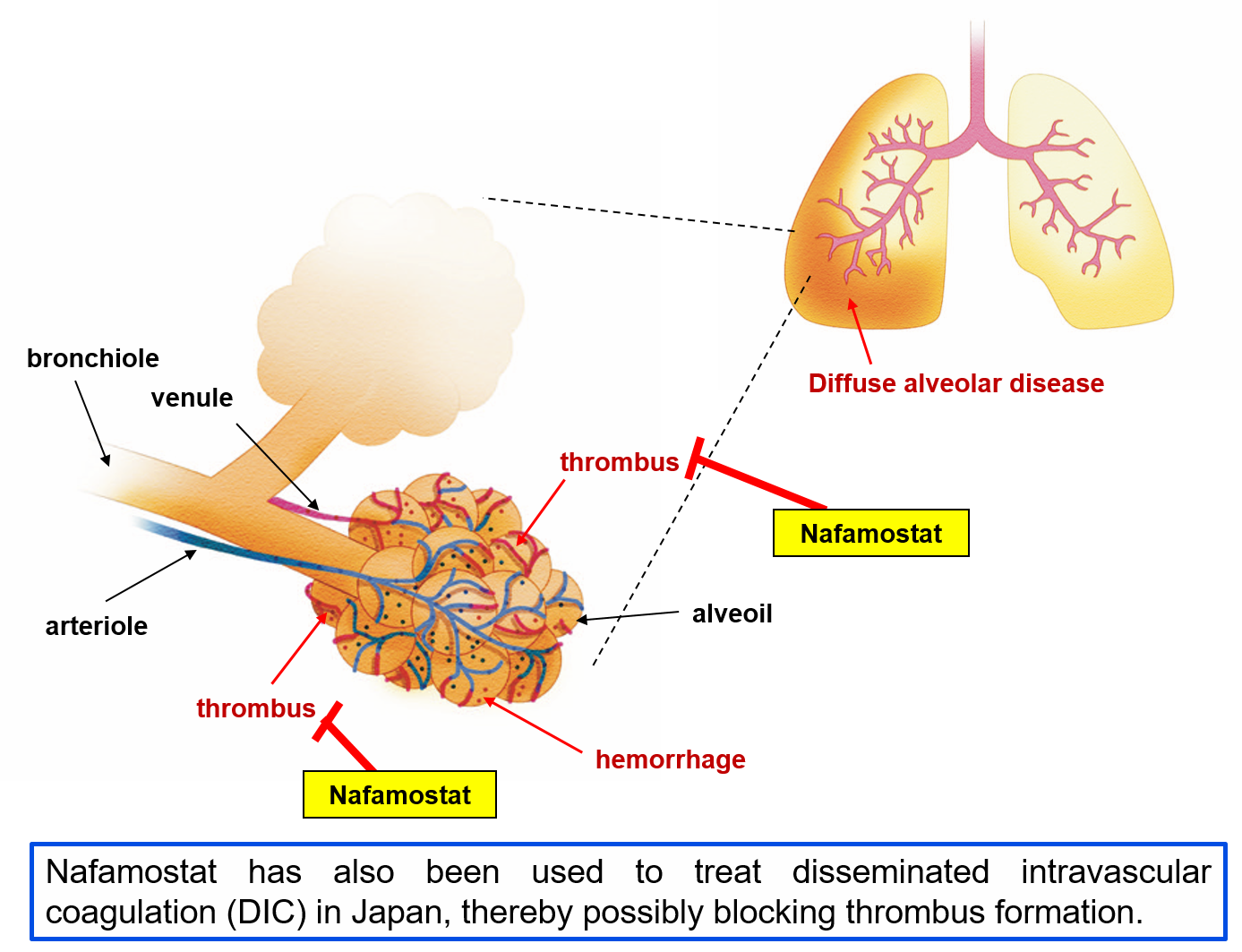 Nafamostat has also been used to treat disseminated intravascular coagulation (DIC) in Japan, thereby possibly blocking thrombus formation. 
